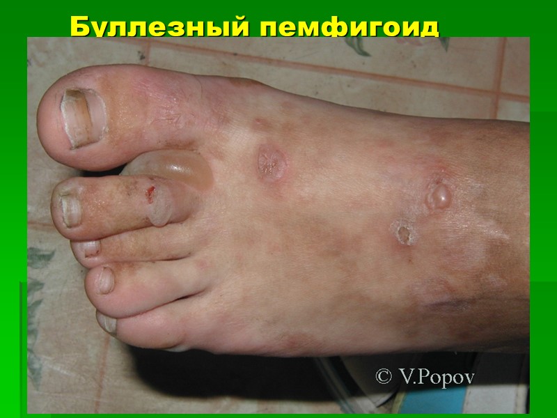 Буллезный пемфигоид